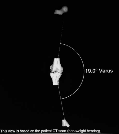 Προεγχειρητική ηλεκτρονική μελέτη της παραμόρφωσης ραιβότητας του δεξιού γόνατος της ασθενούς.  19 μοίρες ραιβότητας δίχως φόρτιση του σκέλους