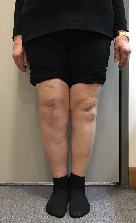 Six weeks post op.  The mechanical axis of the right lower limb is comletely restored