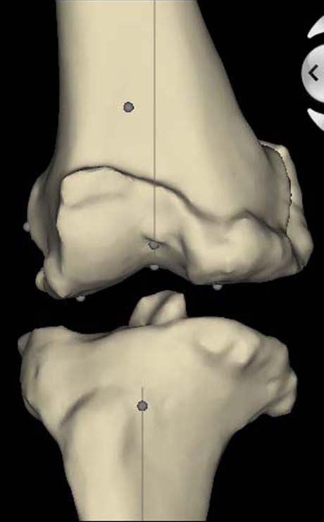 Τρισδιάστατη ηλεκτρονική απεικόνηση του πάσχοντος γόνατος - πρόσθια όψη (ανασύνθεση εικόνων αξονικής τομογραφίας)