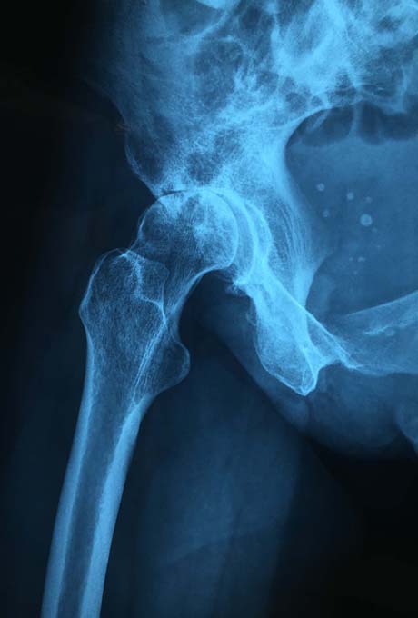 X-ray of the right hip