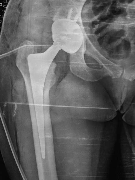 X-ray imediatelly after surgery.  Right hip ALMIS arthroplasty