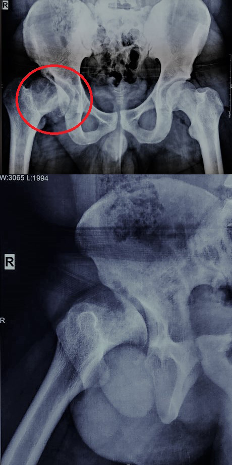 Pre op X-ray of the hips reveals dysplasia and severe arthritis of the right hip