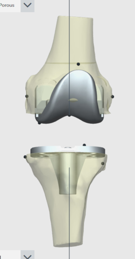 Ηλεκτρονική εφαρμογή του εμφυτεύματος της ολικής αρθροπλαστικής του γόνατος (πρόσθια όψη)