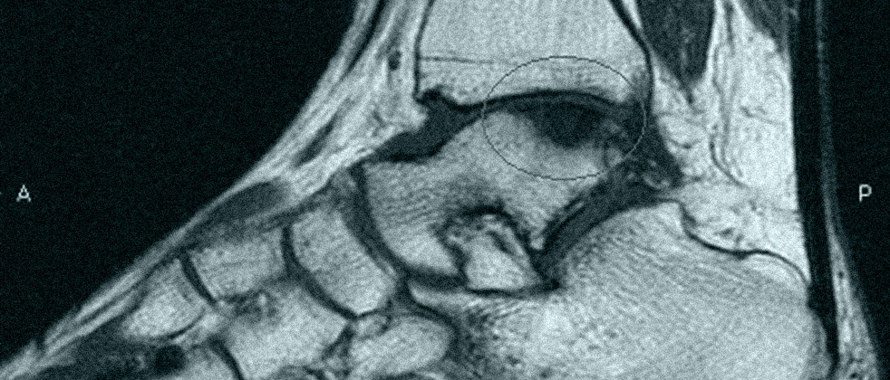 Βλάβες του αρθρικού χόνδρου